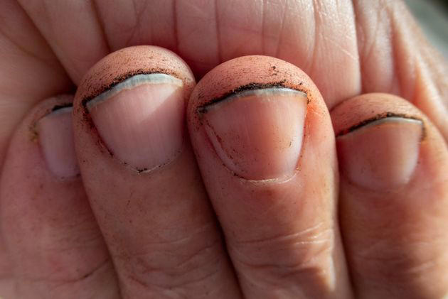 mo thay mong tay bi gay la diem gi may man hay canh bao dieu khong tot 5