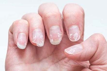 mo thay mong tay bi gay la diem gi may man hay canh bao dieu khong tot 7