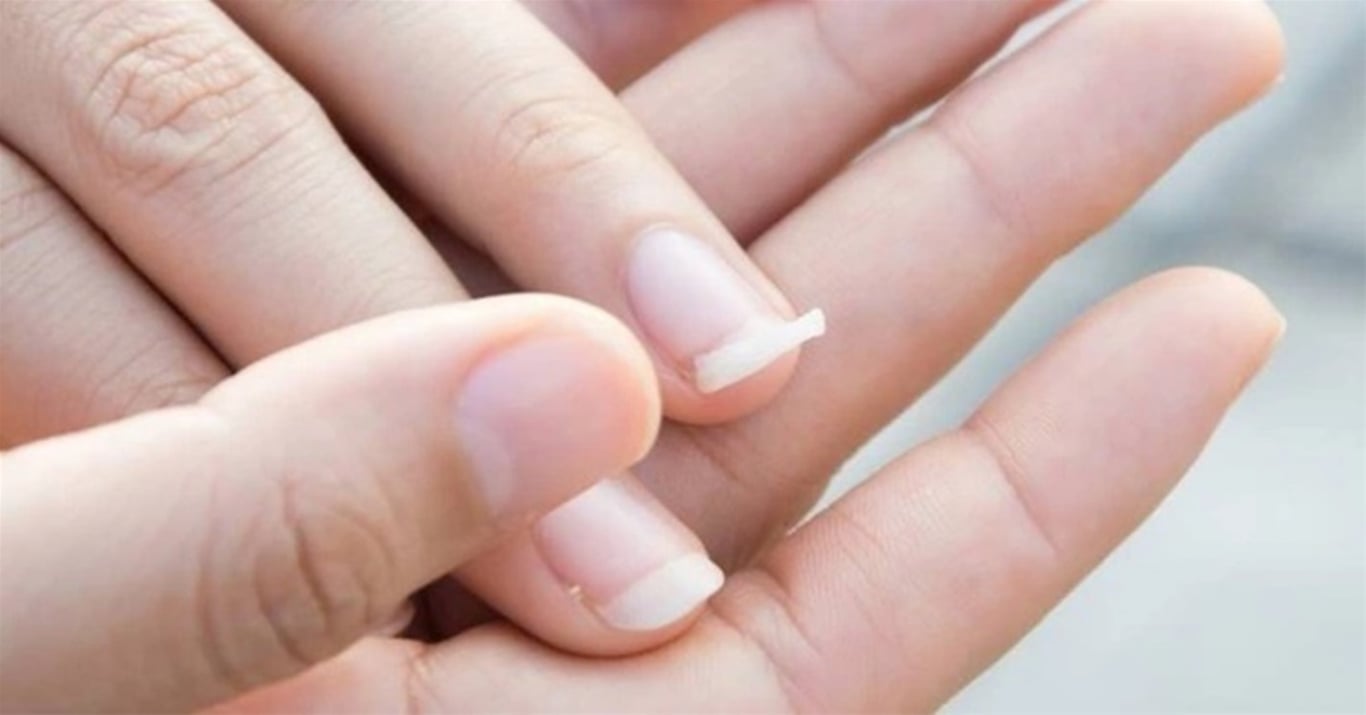 mo thay mong tay bi gay la diem gi may man hay canh bao dieu khong tot 8